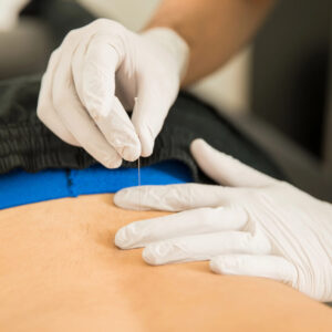 dry needling for back pain calgary downtown