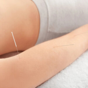 dry needling for tennis elbow calgary downtown