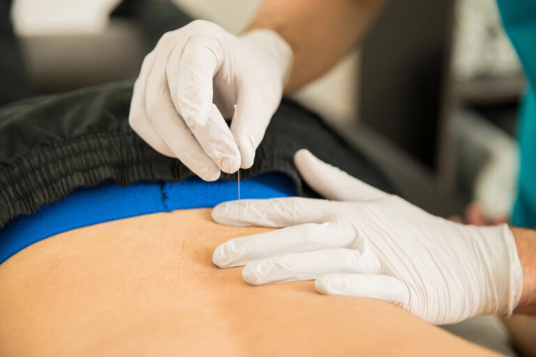 dry needling for sciatica calgary downtown