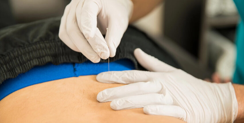 Restore Movement and Reduce Pain: A Guide to Dry Needling for Sciatica