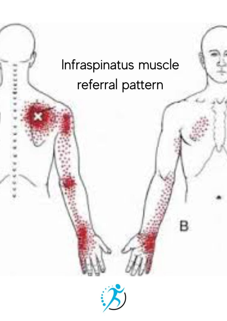 #5 infra referral pattern