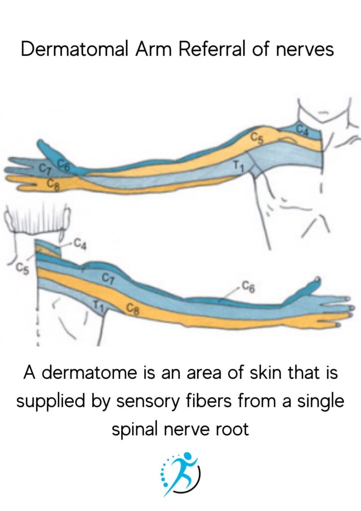 #6 dermatome referral pattern