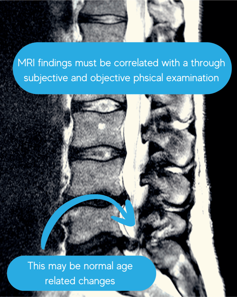 mri findings