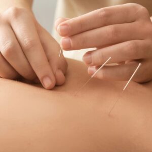 dry needling vs acupuncture calgary downtown