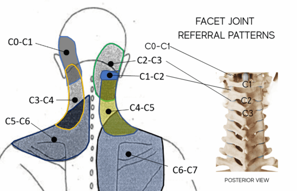 how headaches can be related to neck pain