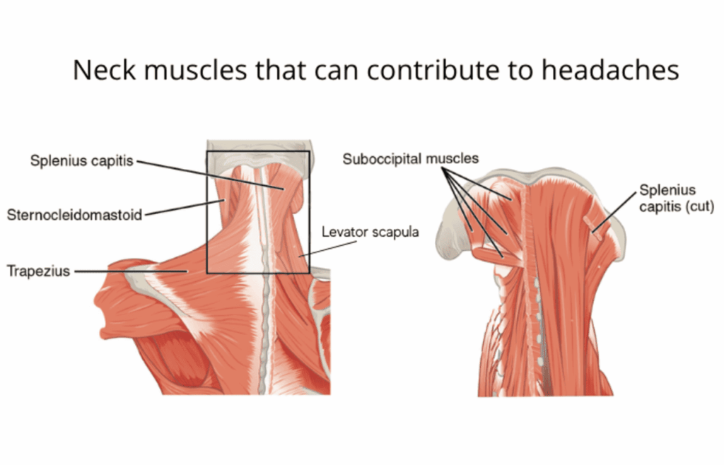 how neck pain leads to headaches