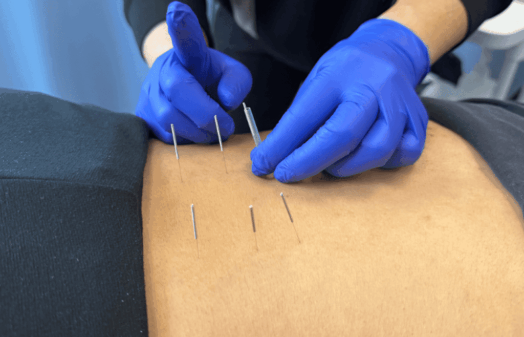 nervous system dry needling ims