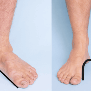 foot physiotherapy for flat feet and high arches
