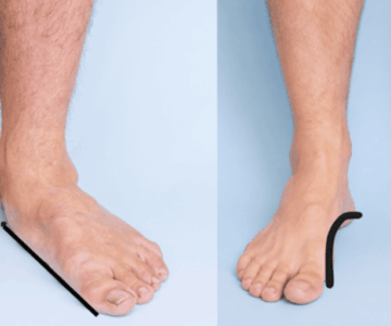 foot physiotherapy for flat feet and high arches