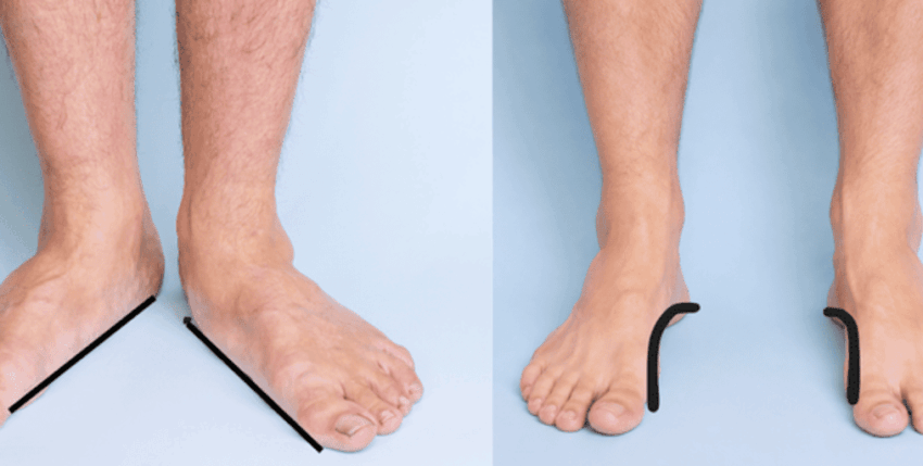 Foot Physiotherapy: Flat Feet and High Arches Explained