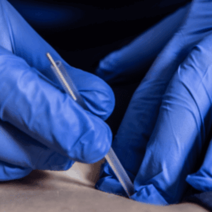 safety of dry needling explained