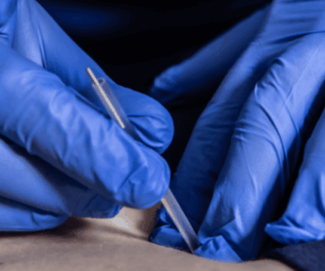safety of dry needling explained