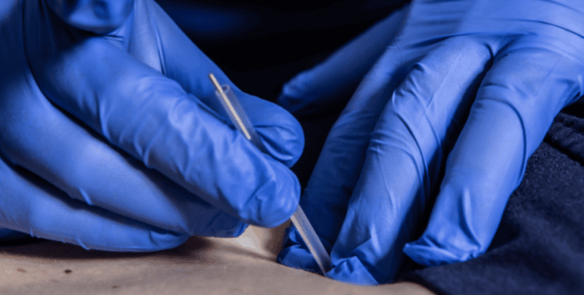 Is Dry Needling Safe? What You Should Know Before Treatment