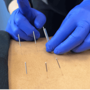 dry needling vs acupuncture