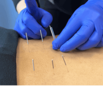 dry needling vs acupuncture