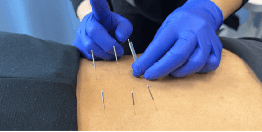 Dry Needling vs Acupuncture: Same Needles, Different Clinical Approach