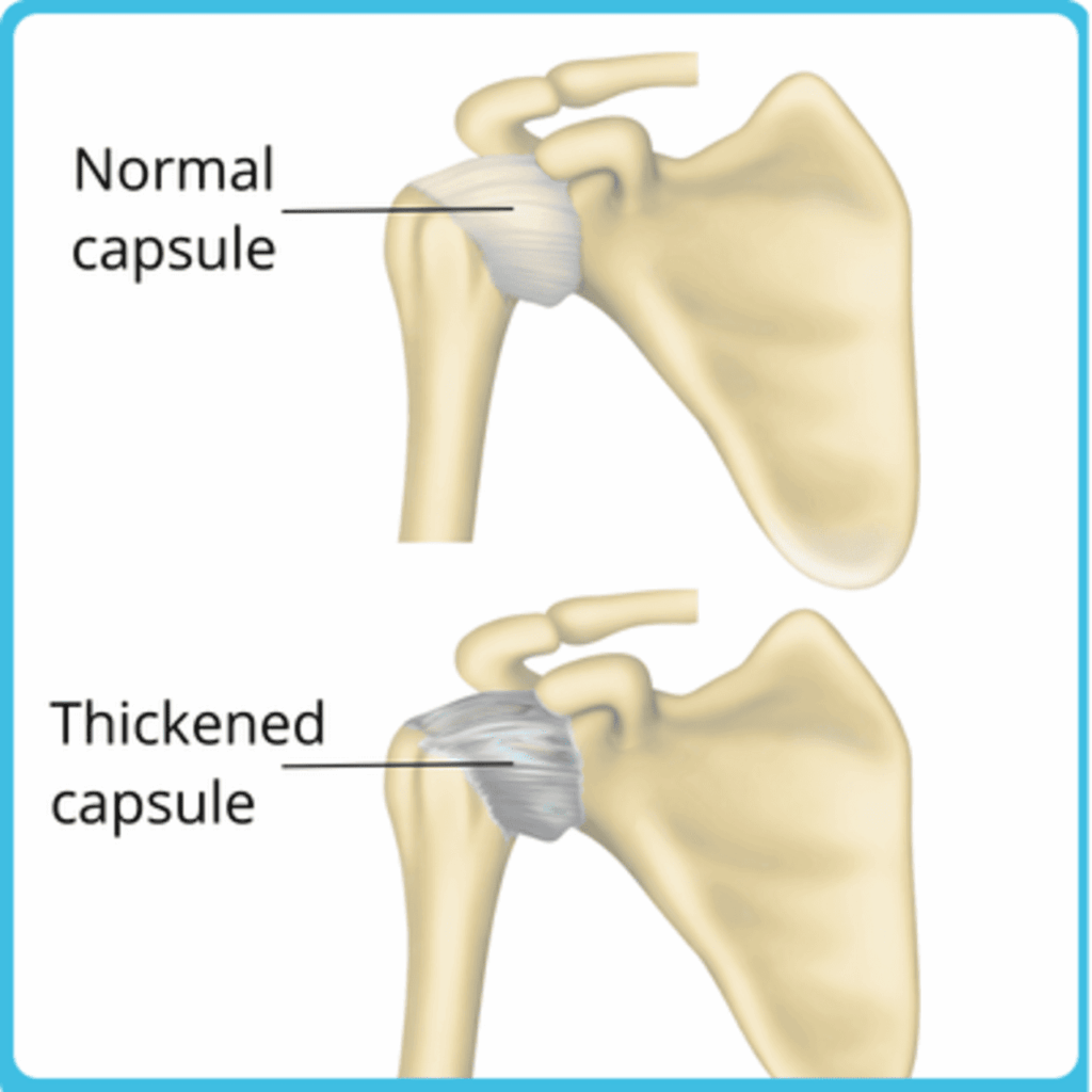 rotator cuff pain when lying down